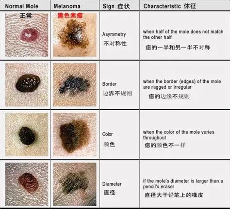 有問題的痣|痣有4種顏色，出現在「手腳這邊」的痣可能是皮膚。